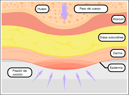 Antiescaras Ulceras Reduccion Presion